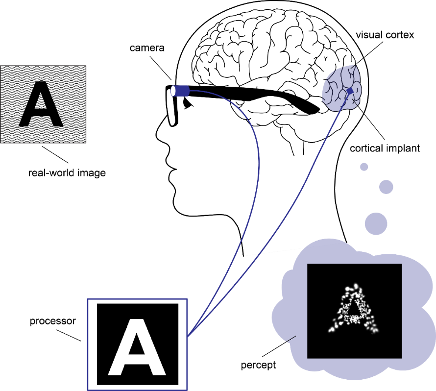 Schematic illustration of a cortical visual neuro-prosthesis: a head-mounted camera captures the visual environment, a mobile processor converts it into a stimulation pattern, and an electrode array implanted in the primary visual cortex (V1) evokes a percept of phosphenes that sketches the original scene.